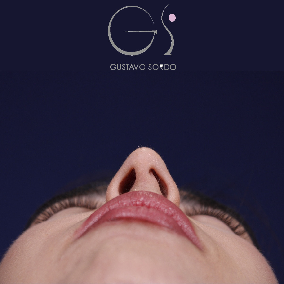 Rinoplastia ultrasónica combinada con mentoplastia — antes. Caso operado por el Dr. Gustavo Sordo en Madrid