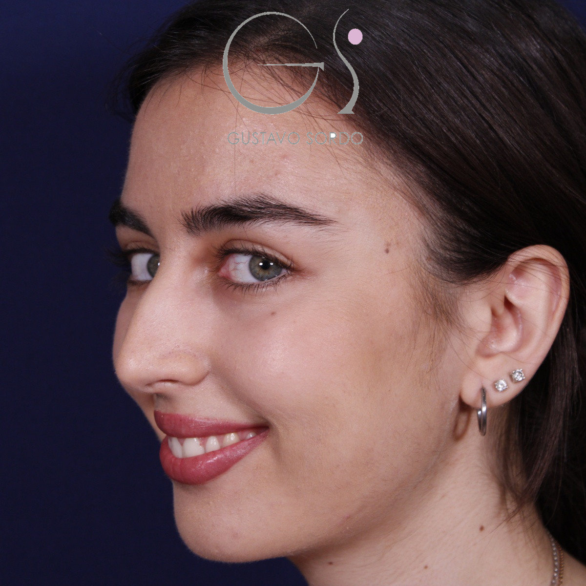Rinoplastia ultrasónica combinada con mentoplastia — antes. Caso operado por el Dr. Gustavo Sordo en Madrid