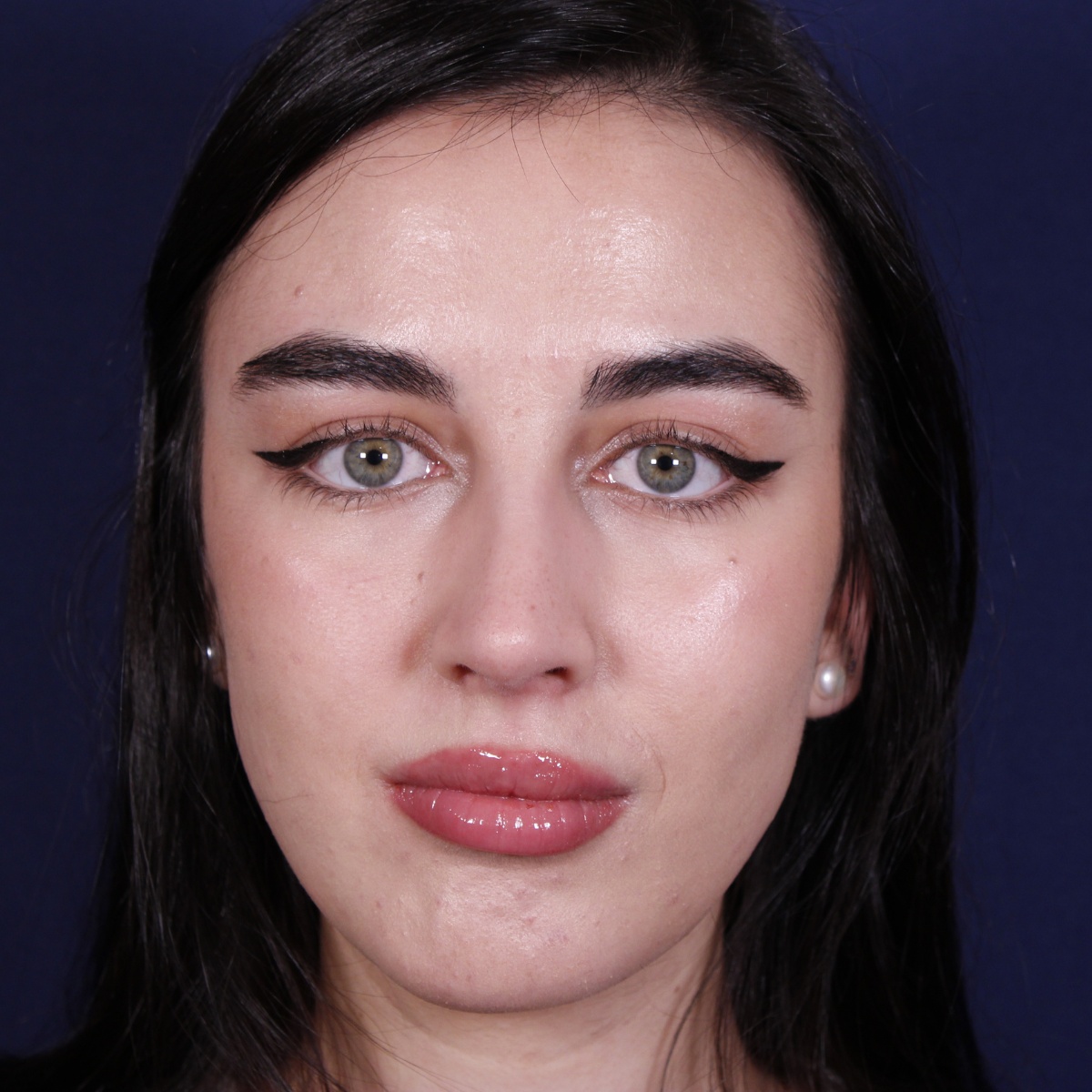 Rinoplastia ultrasónica combinada con mentoplastia — después. Caso operado por el Dr. Gustavo Sordo en Madrid
