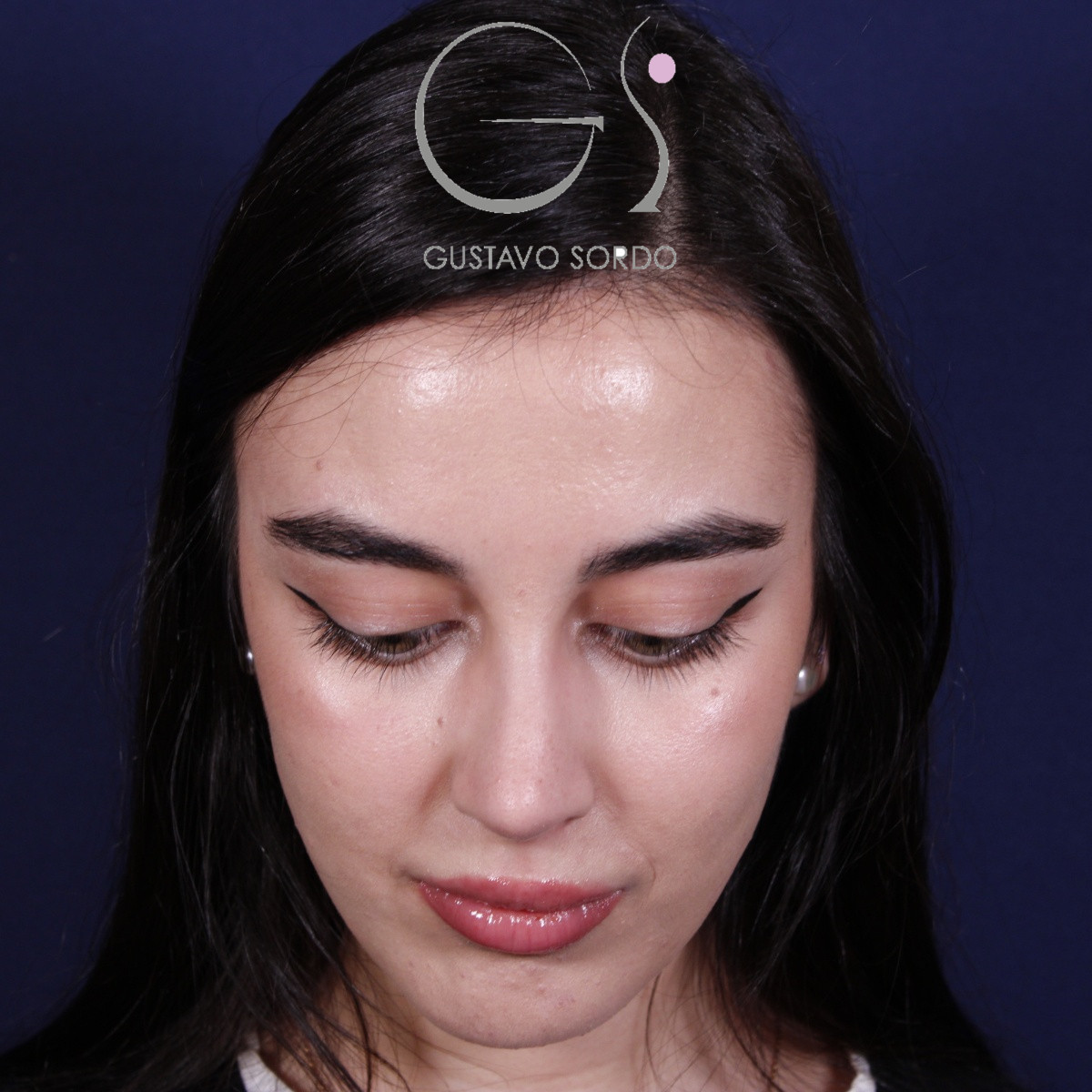 Rinoplastia ultrasónica combinada con mentoplastia — después. Caso operado por el Dr. Gustavo Sordo en Madrid