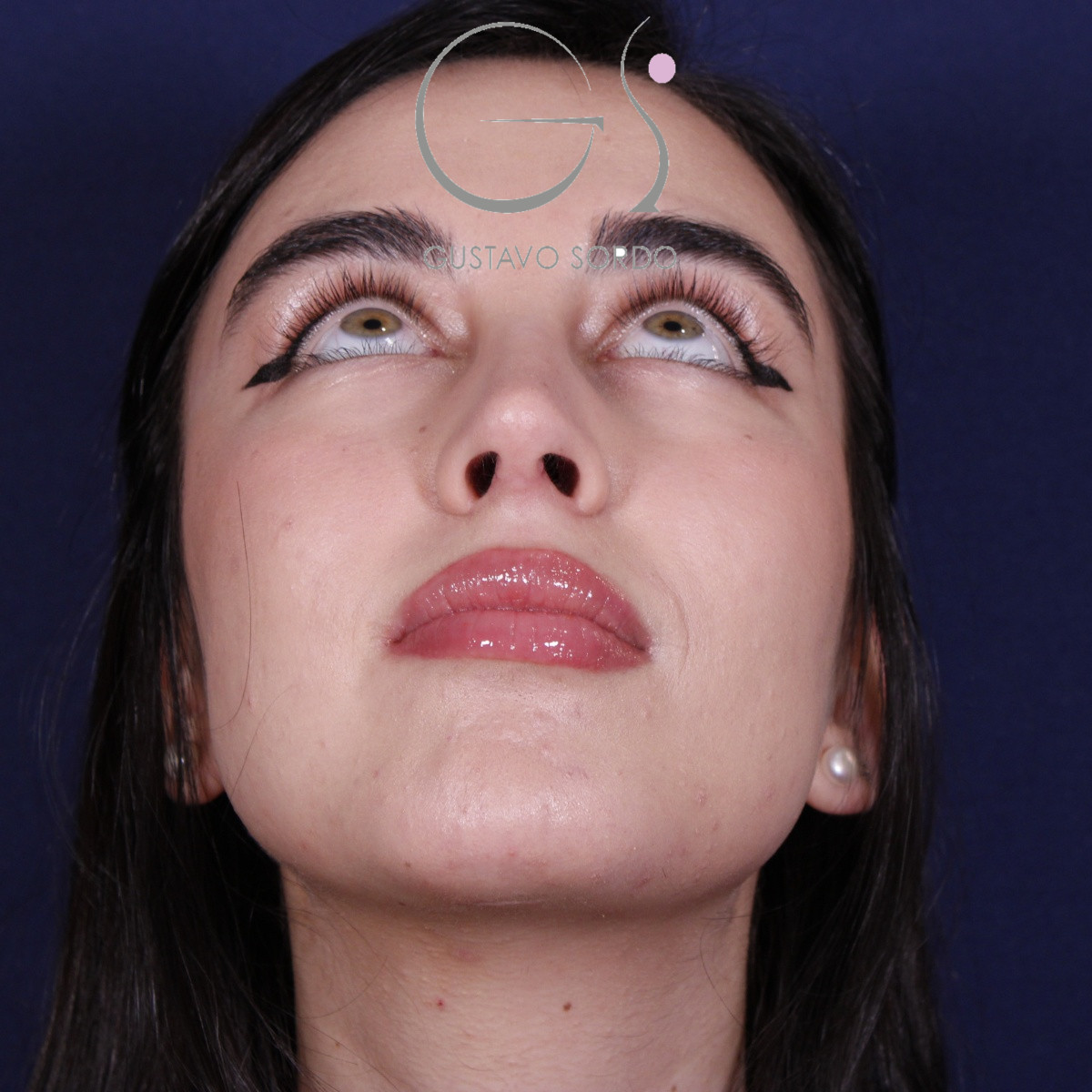 Rinoplastia ultrasónica combinada con mentoplastia — después. Caso operado por el Dr. Gustavo Sordo en Madrid