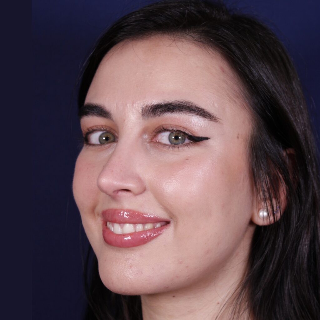 Rinoplastia ultrasónica combinada con mentoplastia — después. Caso operado por el Dr. Gustavo Sordo en Madrid