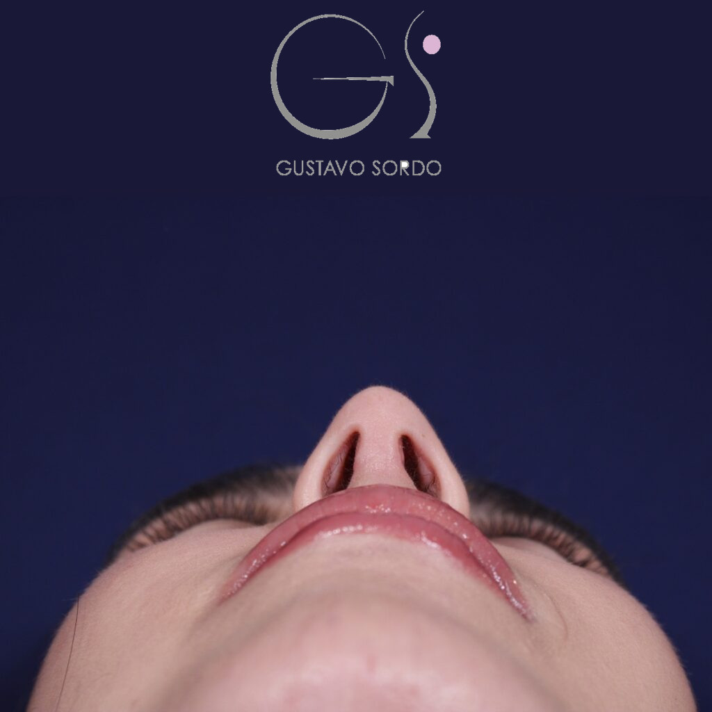 Rinoplastia ultrasónica combinada con mentoplastia — después. Caso operado por el Dr. Gustavo Sordo en Madrid