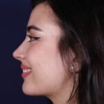 Rinoplastia en Madrid