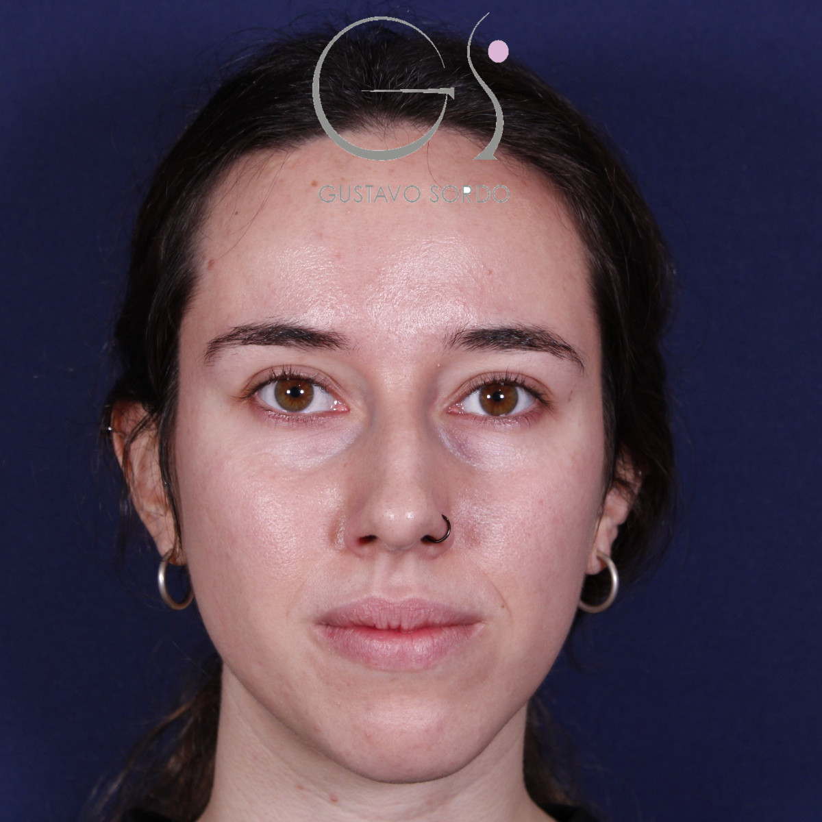 Rinoplastia ultrasónica en mujer con nariz aguileña, antes de la operación (1)
