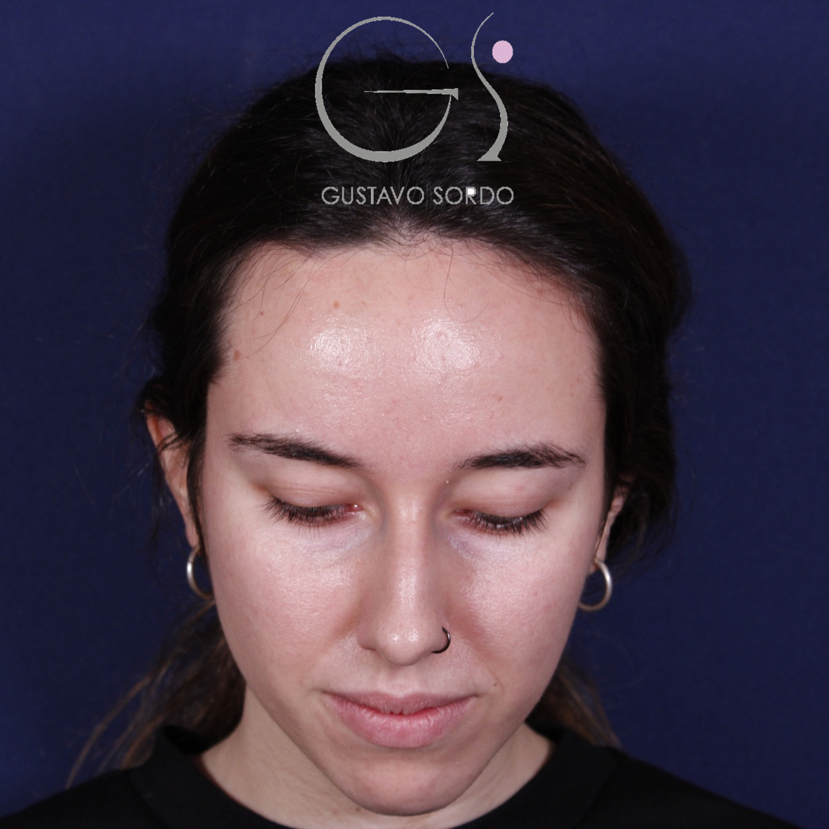 Rinoplastia ultrasónica en mujer con nariz aguileña, antes de la operación (2)