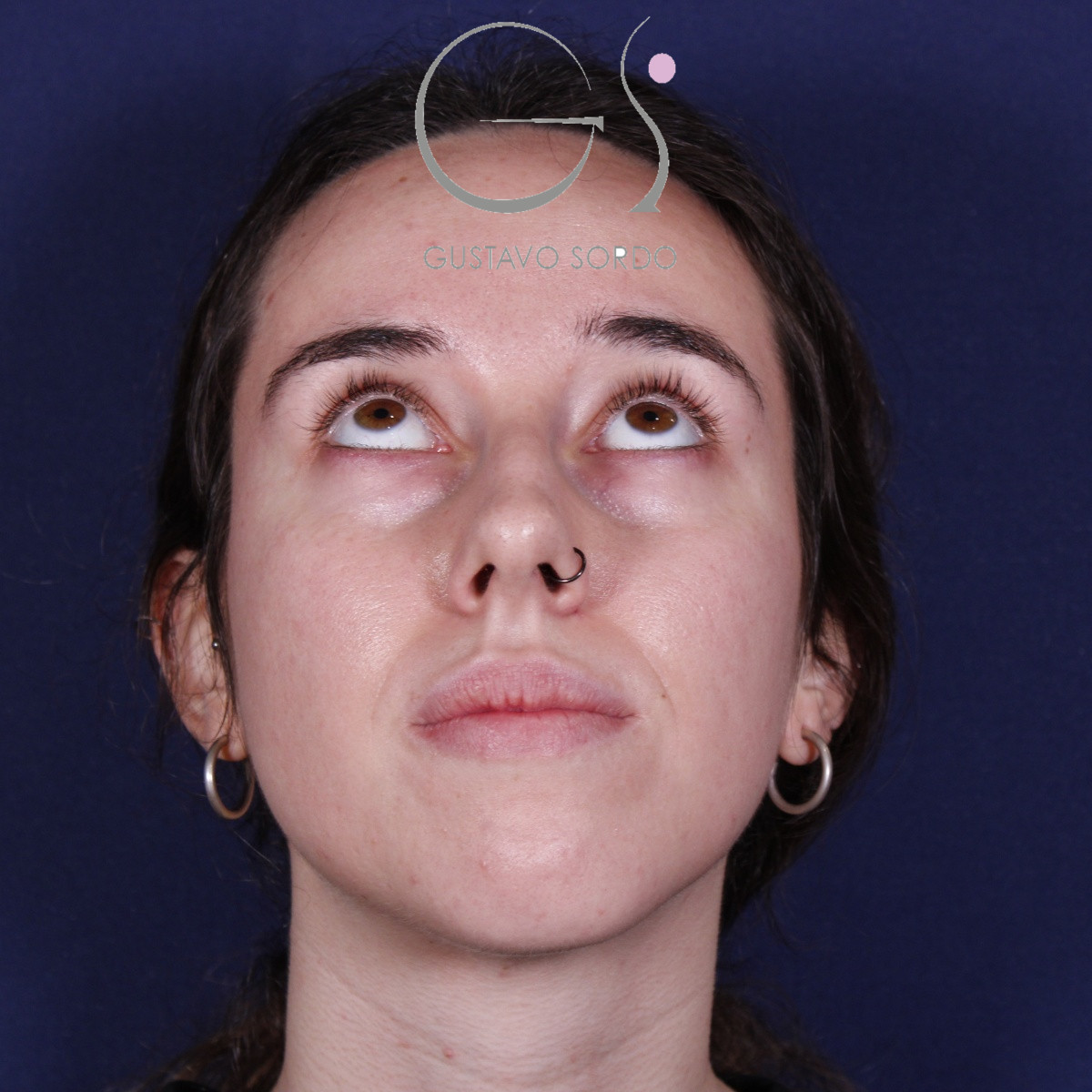 Rinoplastia ultrasónica en mujer con nariz aguileña, antes de la operación (3)