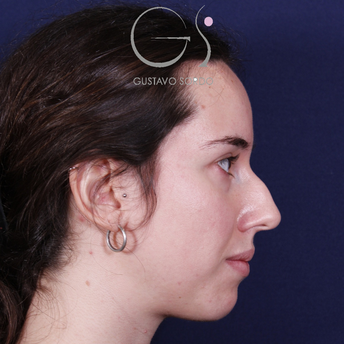 Rinoplastia ultrasónica en mujer con nariz aguileña, antes de la operación (4)