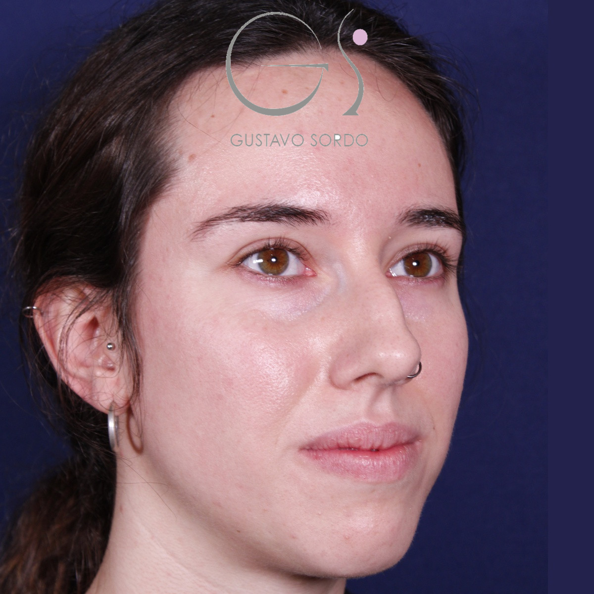 Rinoplastia ultrasónica en mujer con nariz aguileña, antes de la operación (5)