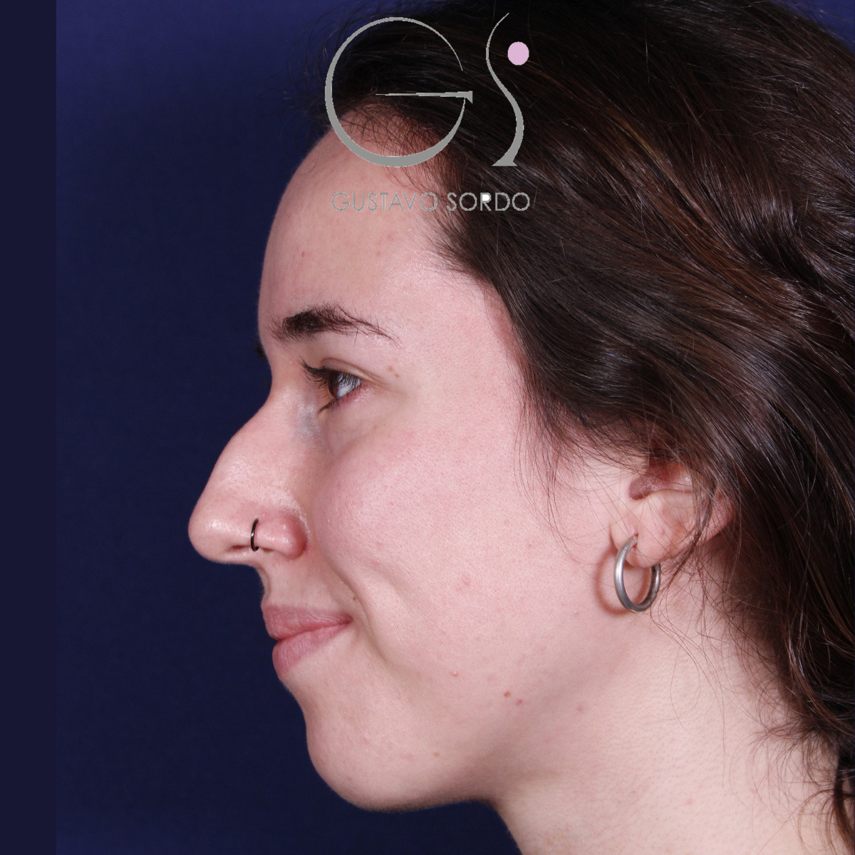 Rinoplastia ultrasónica en mujer con nariz aguileña, antes de la operación (6)