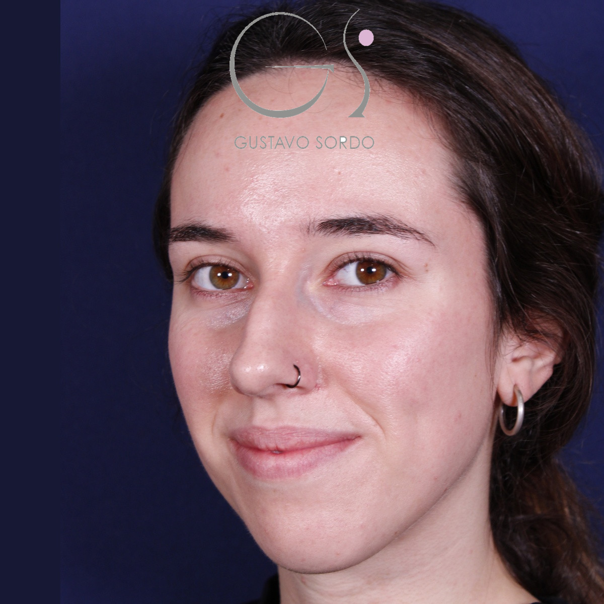 Rinoplastia ultrasónica en mujer con nariz aguileña, antes de la operación (7)