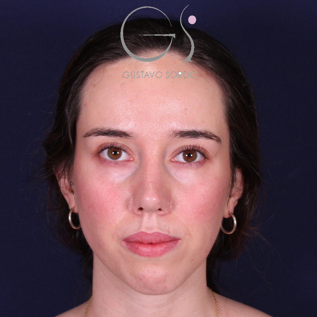 Rinoplastia ultrasónica en mujer con nariz aguileña, después de la operación (1)