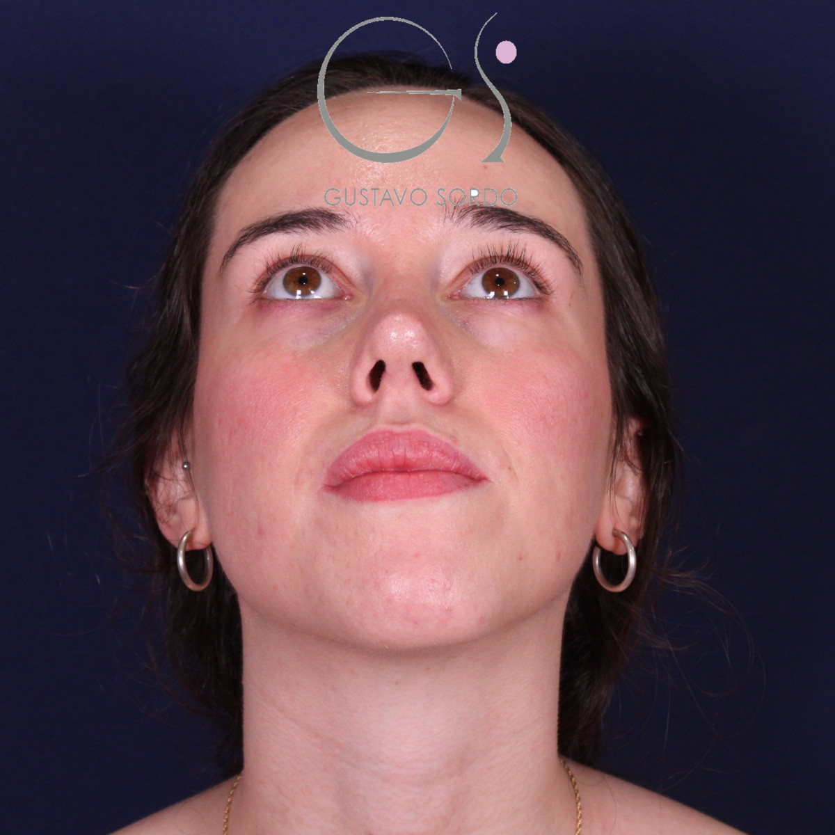 Rinoplastia ultrasónica en mujer con nariz aguileña, después de la operación (3)