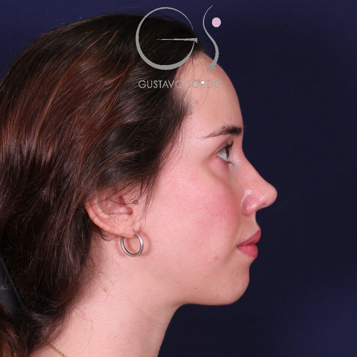 Rinoplastia ultrasónica en mujer con nariz aguileña, después de la operación (4)