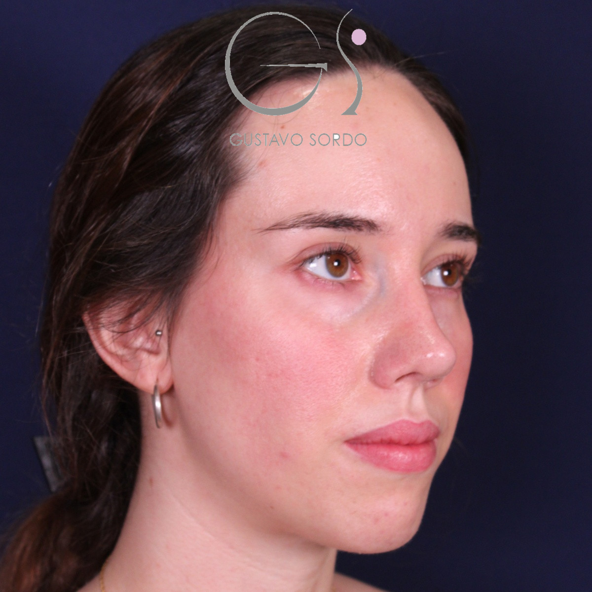 Rinoplastia ultrasónica en mujer con nariz aguileña, después de la operación (5)