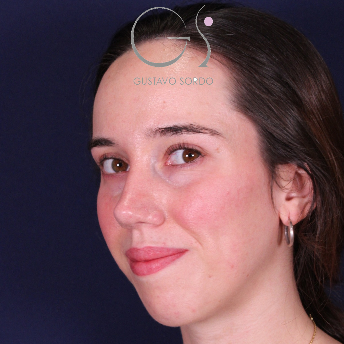 Rinoplastia ultrasónica en mujer con nariz aguileña, después de la operación (7)