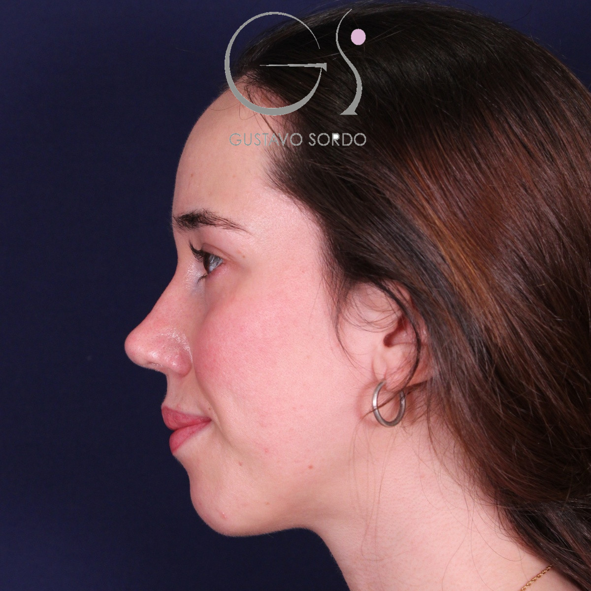 Rinoplastia ultrasónica en mujer con nariz aguileña, después de la operación (6)