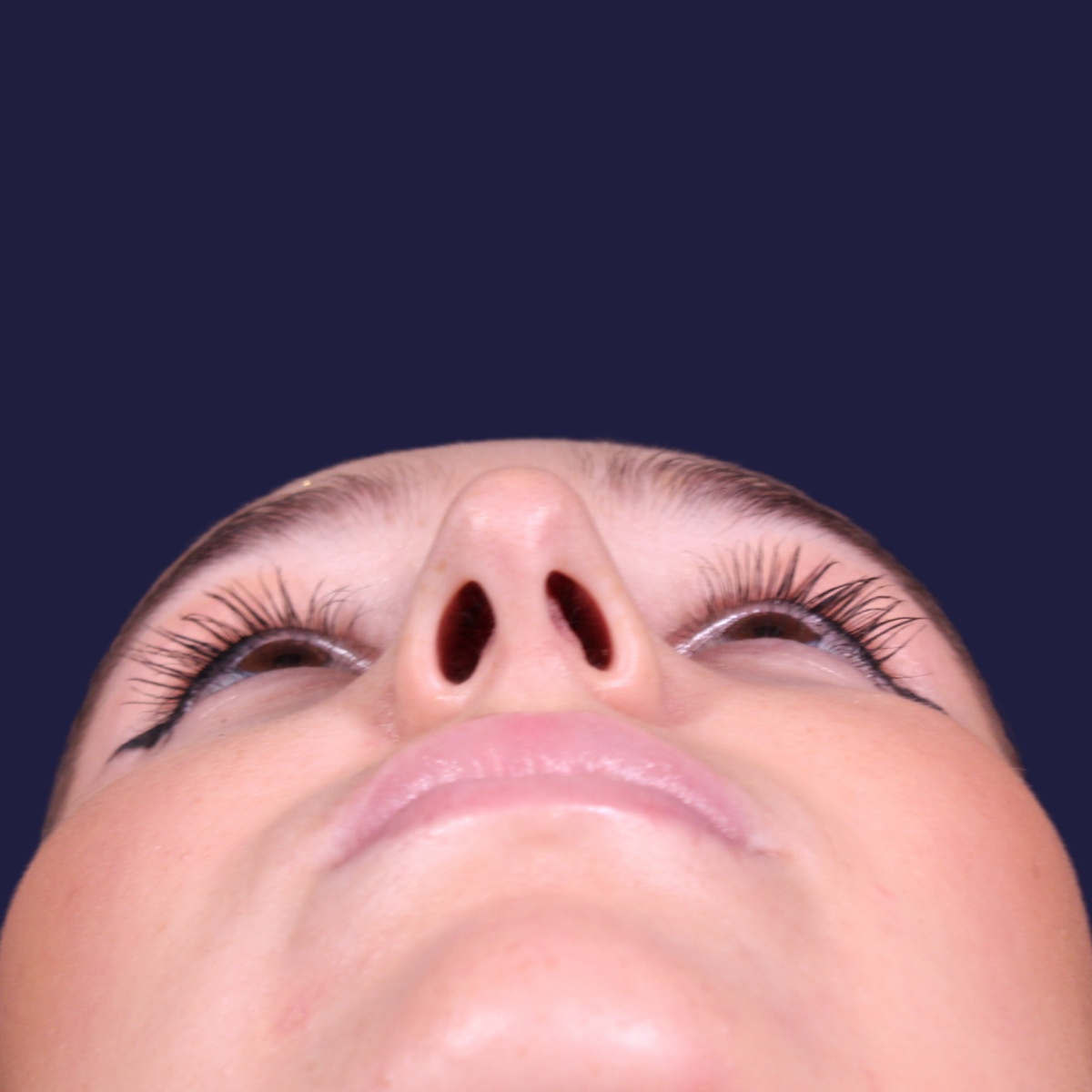 Rinoplastia, antes de la cirugía — caso operado por el Dr. Gustavo Sordo en Madrid (4)