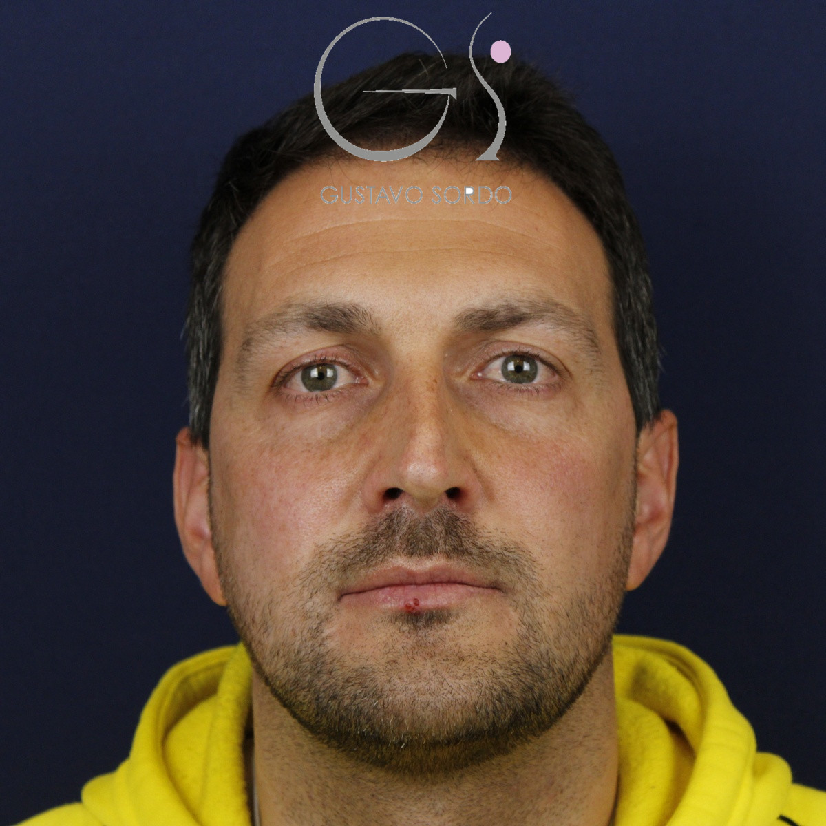 Rinoplastia estructural con corrección de desviación y colapso de válvula externa — antes. Caso operado por el Dr. Gustavo Sordo en Madrid