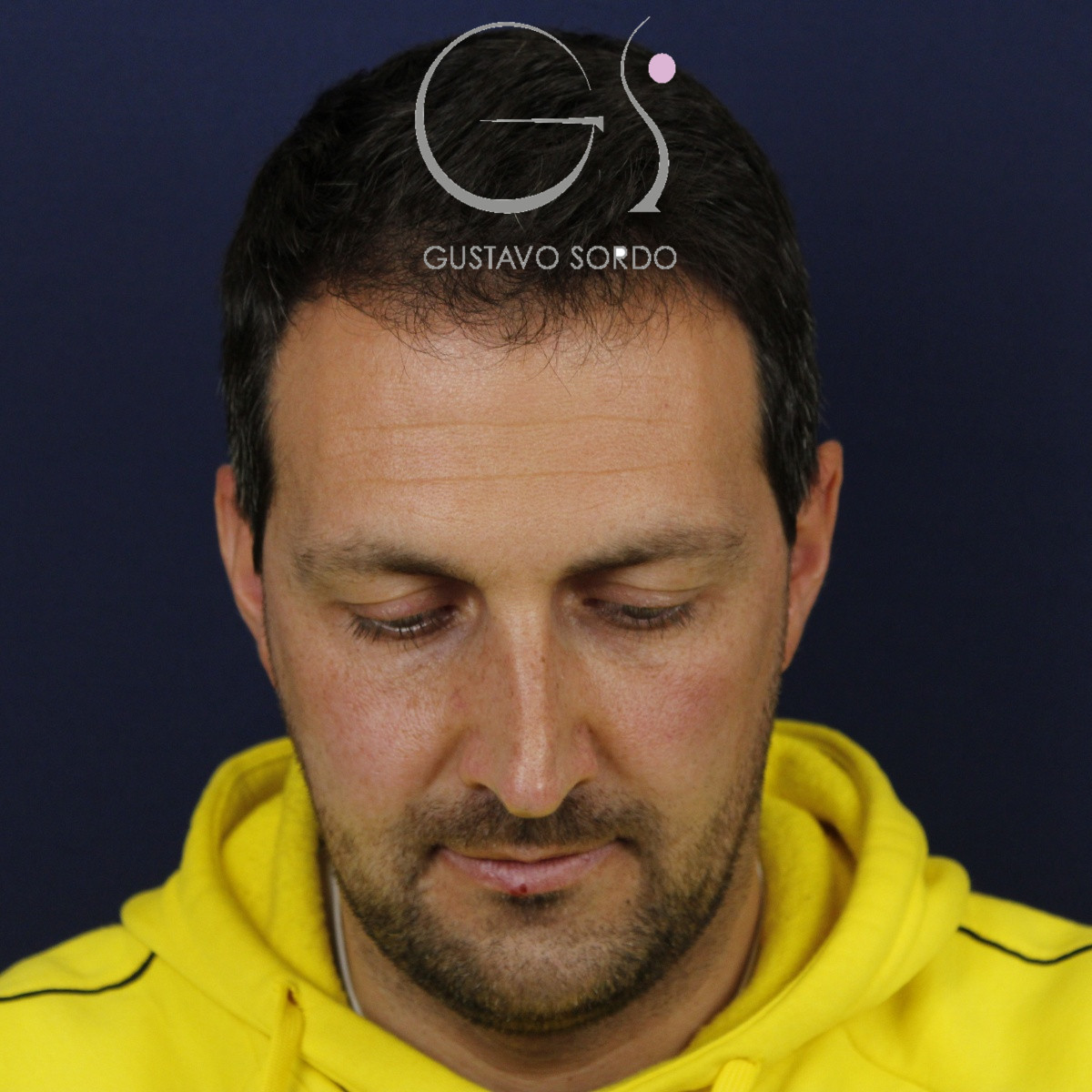 Rinoplastia estructural con corrección de desviación y colapso de válvula externa — antes. Caso operado por el Dr. Gustavo Sordo en Madrid