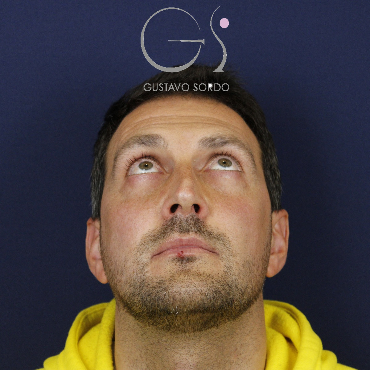 Rinoplastia estructural con corrección de desviación y colapso de válvula externa — antes. Caso operado por el Dr. Gustavo Sordo en Madrid