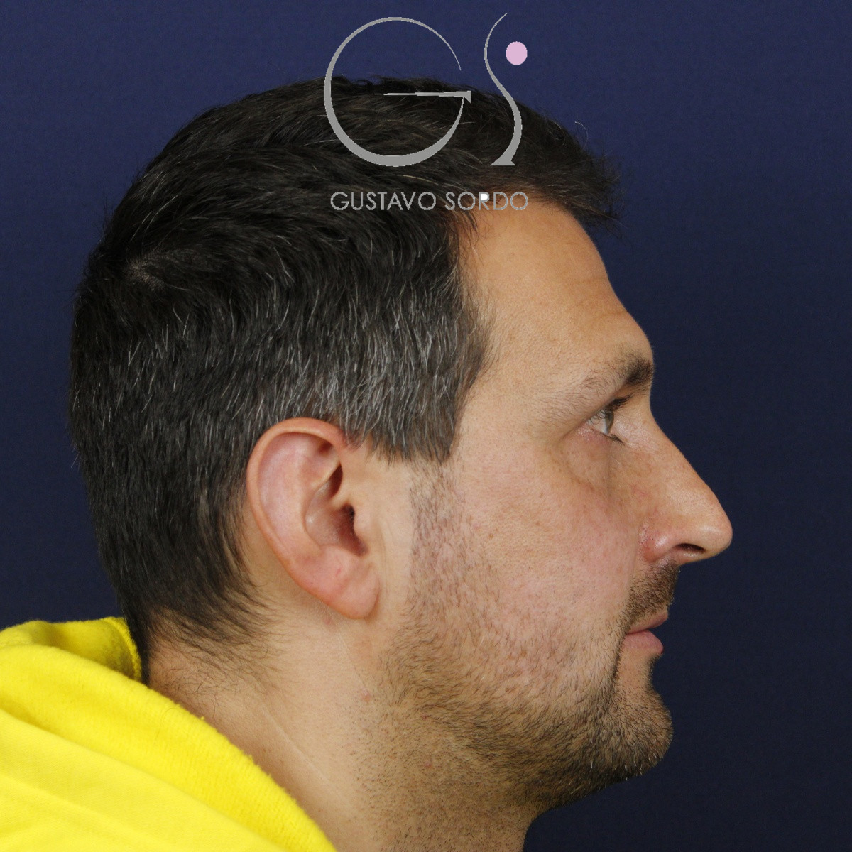 Rinoplastia estructural con corrección de desviación y colapso de válvula externa — antes. Caso operado por el Dr. Gustavo Sordo en Madrid
