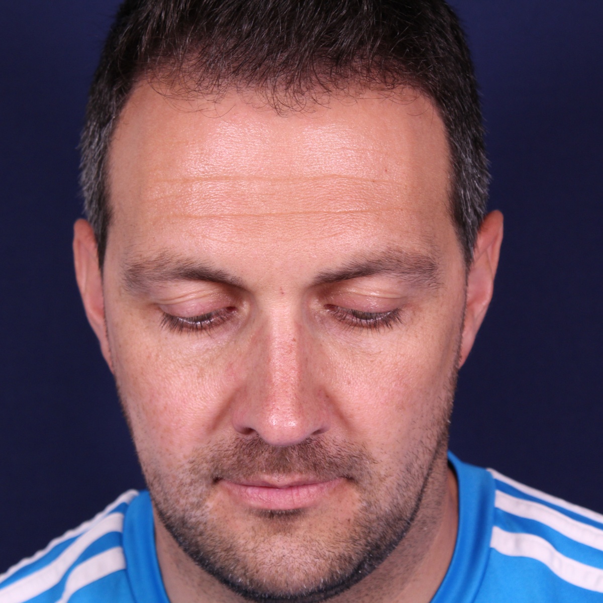 Rinoplastia estructural con corrección de desviación y colapso de válvula externa — después. Caso operado por el Dr. Gustavo Sordo en Madrid