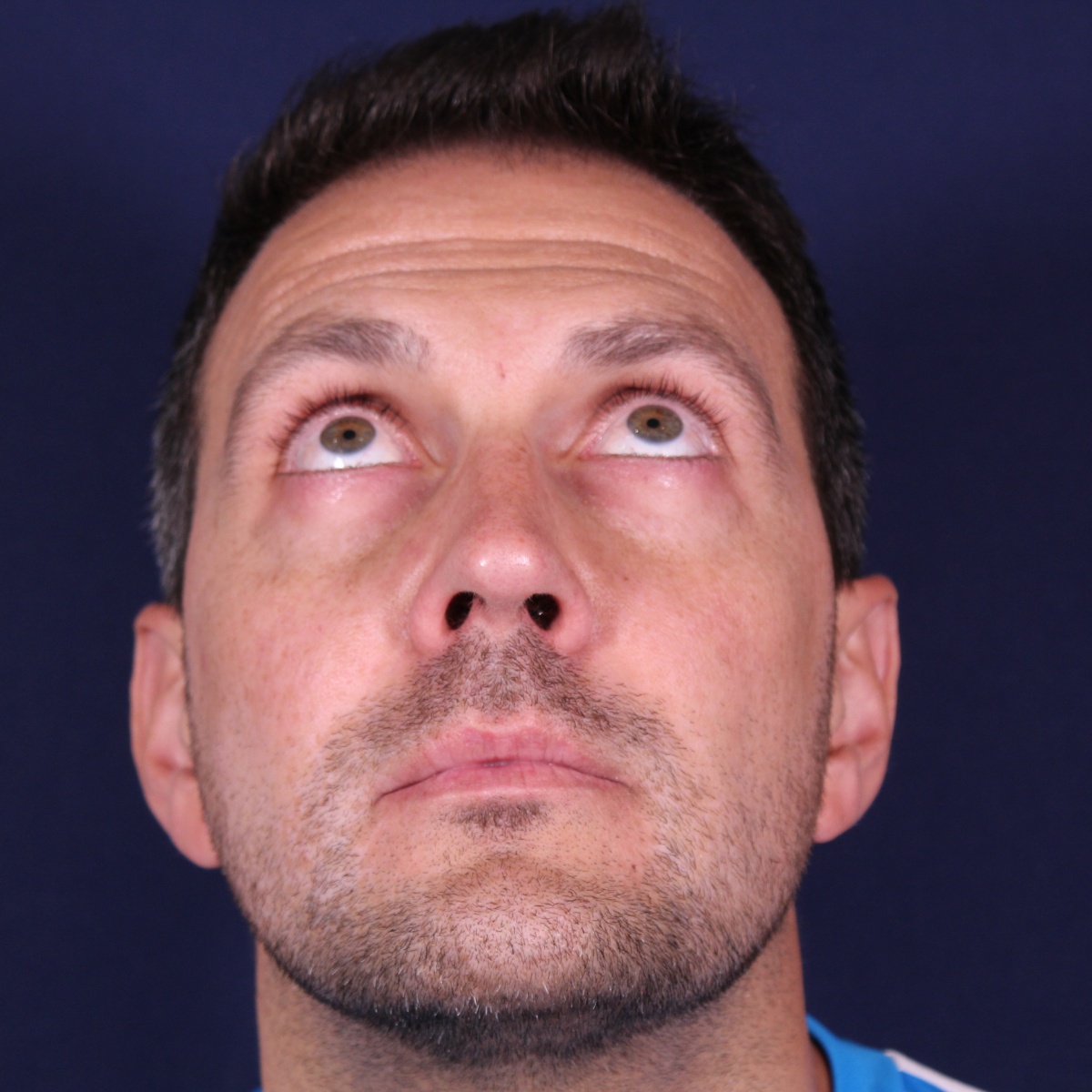 Rinoplastia estructural con corrección de desviación y colapso de válvula externa — después. Caso operado por el Dr. Gustavo Sordo en Madrid
