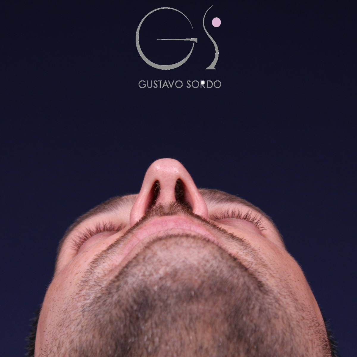 Rinoplastia estructural con corrección de desviación y colapso de válvula externa — después. Caso operado por el Dr. Gustavo Sordo en Madrid
