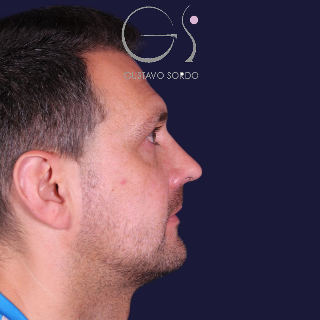 Rinoplastia estructural con corrección de desviación y colapso de válvula externa — después. Caso operado por el Dr. Gustavo Sordo en Madrid
