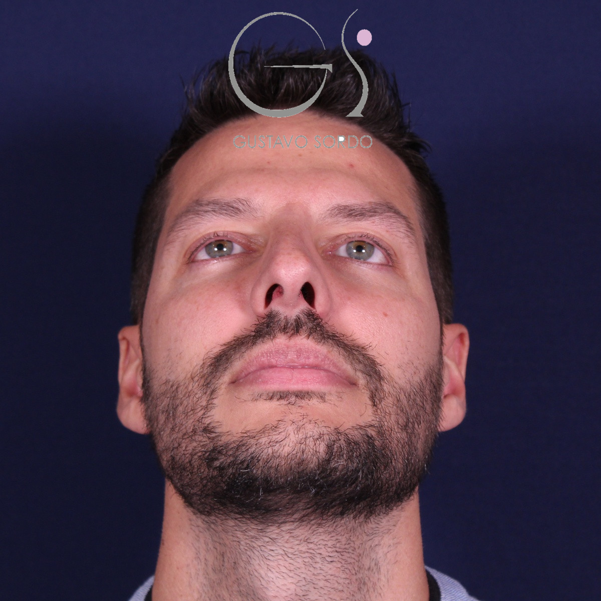 Rinoplastia ultrasónica en hombre con piel gruesa, antes de la operación (2)