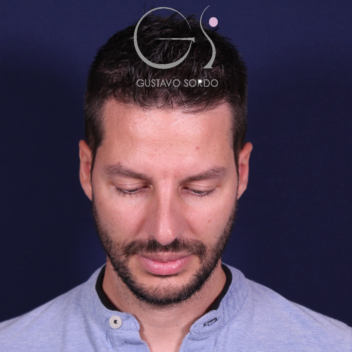 Rinoplastia ultrasónica en hombre con piel gruesa, antes de la operación (3)