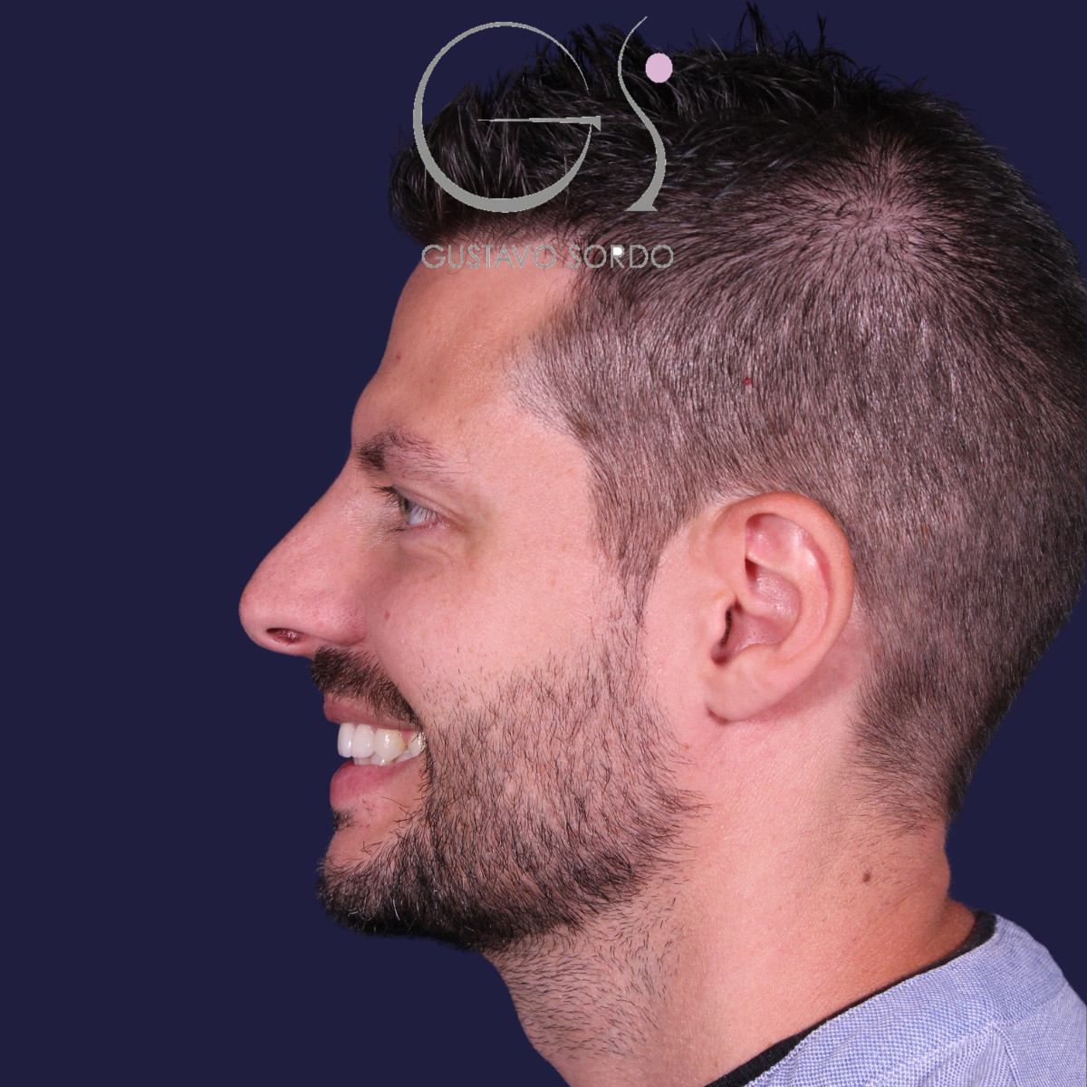 Rinoplastia ultrasónica en hombre con piel gruesa, antes de la operación (4)