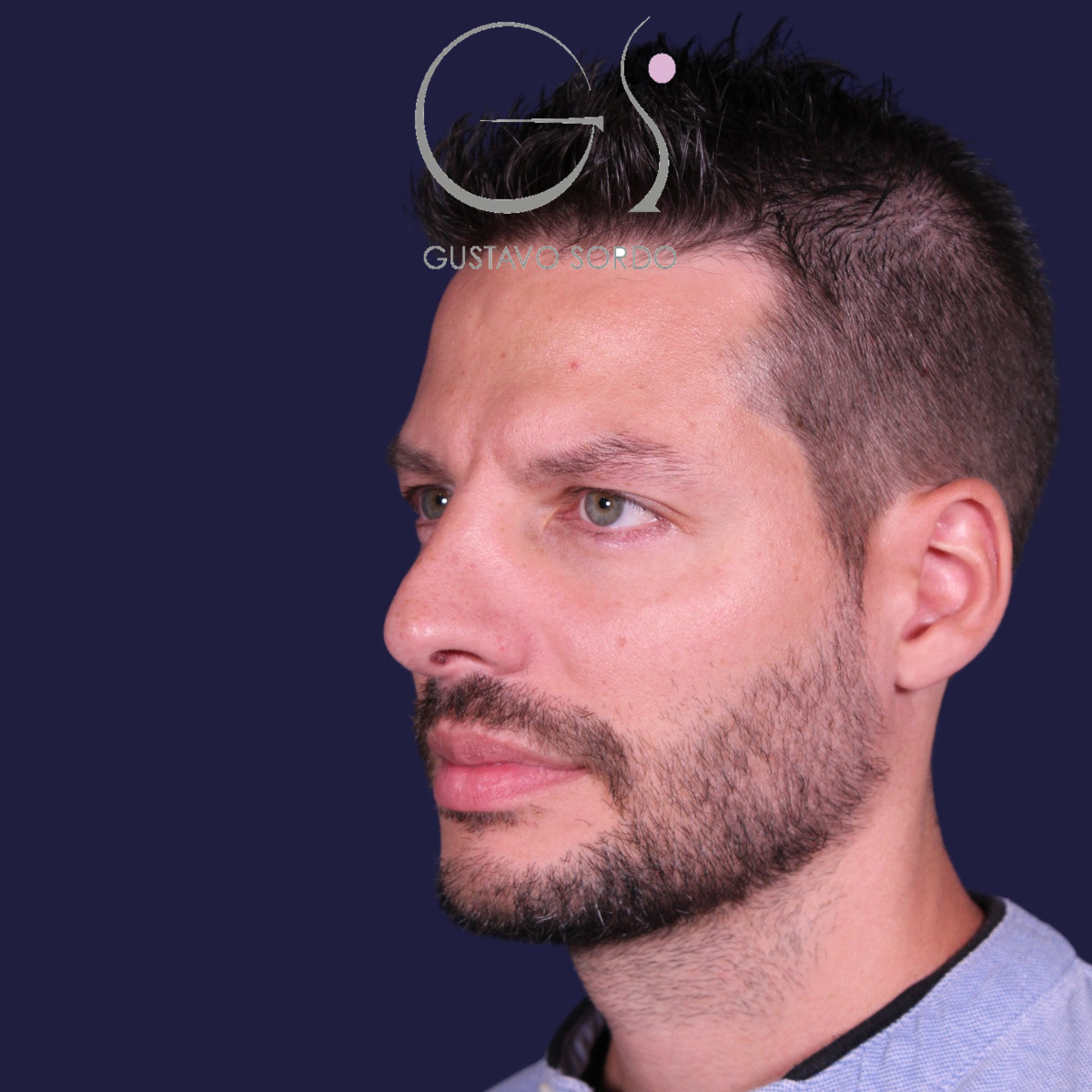 Rinoplastia ultrasónica en hombre con piel gruesa, antes de la operación (5)