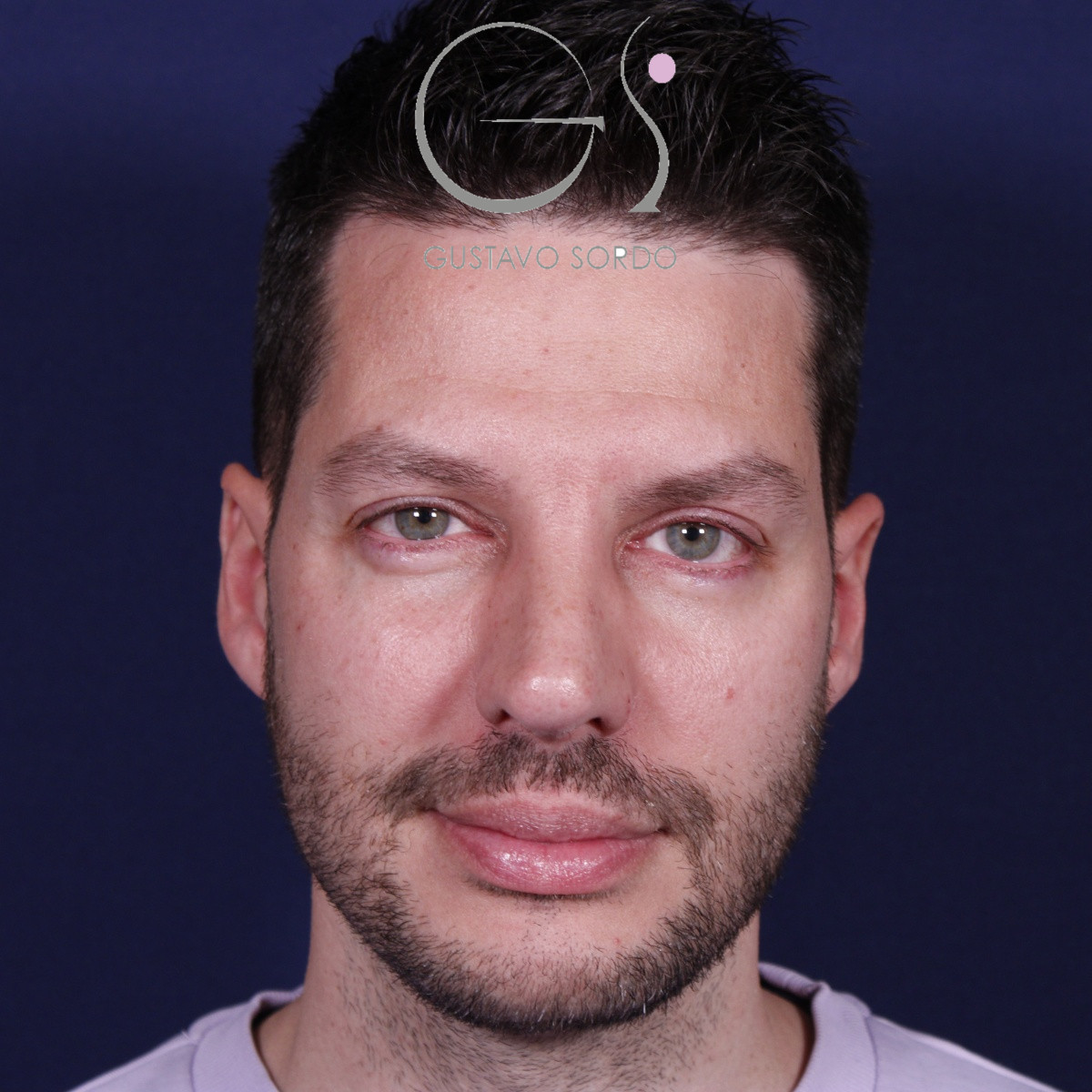 Rinoplastia ultrasónica en hombre con piel gruesa, después de la operación (1)