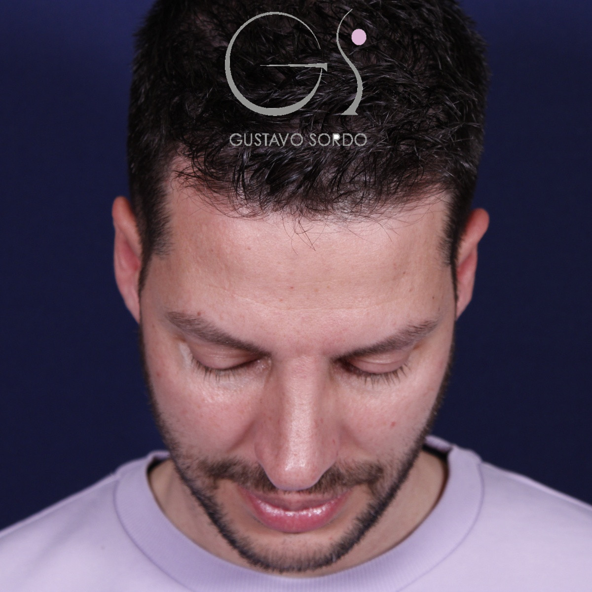 Rinoplastia ultrasónica en hombre con piel gruesa, después de la operación (3)