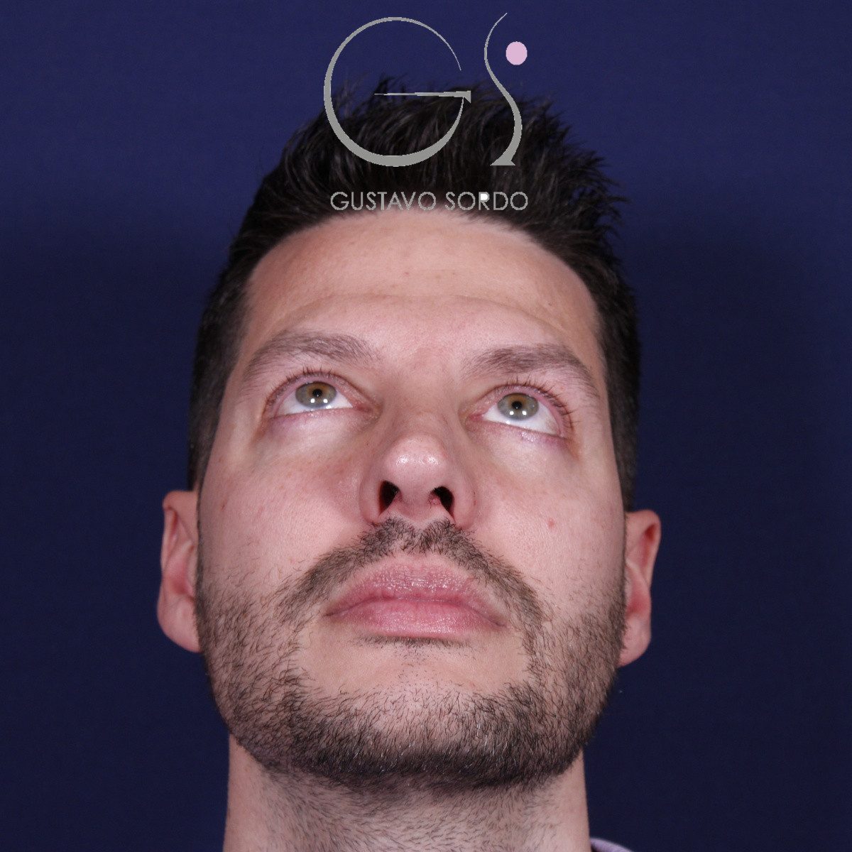 Rinoplastia ultrasónica en hombre con piel gruesa, después de la operación (2)