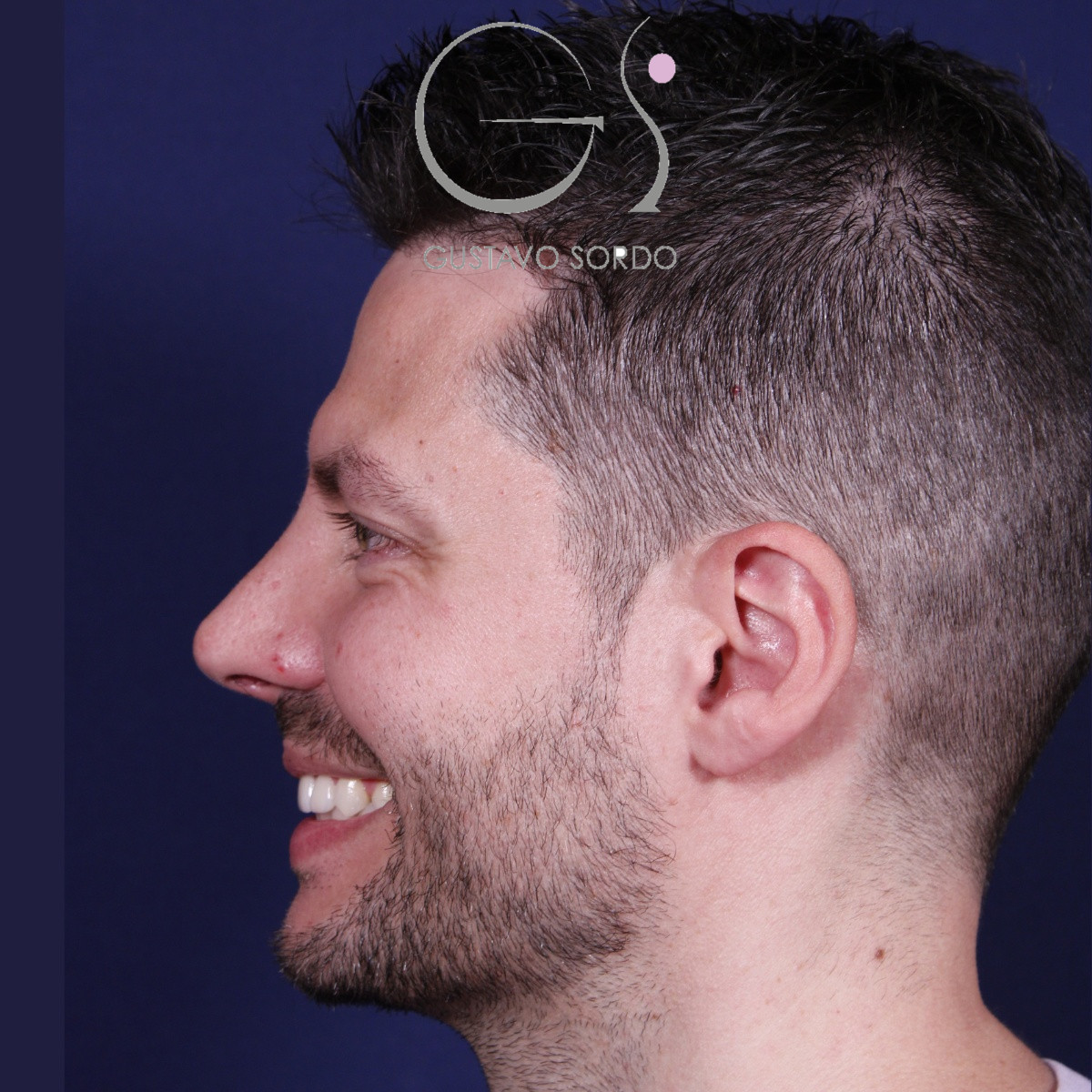 Rinoplastia ultrasónica en hombre con piel gruesa, después de la operación (4)