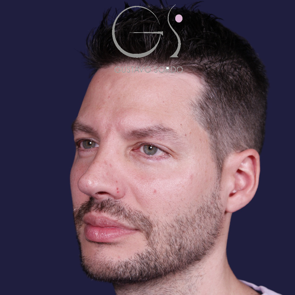 Rinoplastia ultrasónica en hombre con piel gruesa, después de la operación (5)