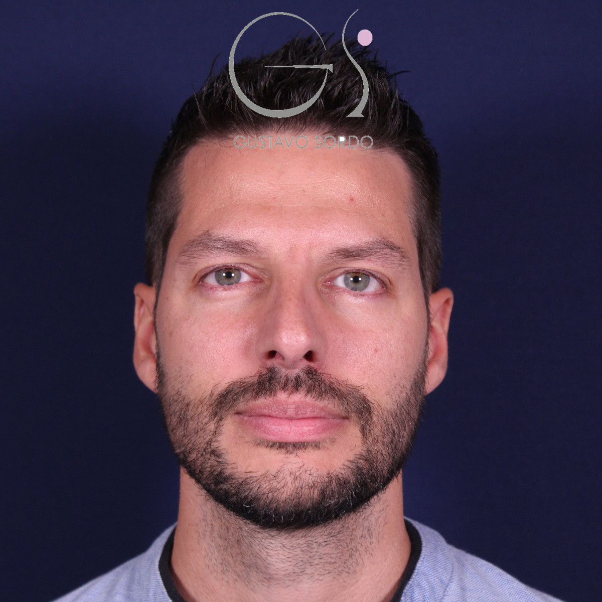 Rinoplastia ultrasónica en hombre con piel gruesa, antes de la operación (1)