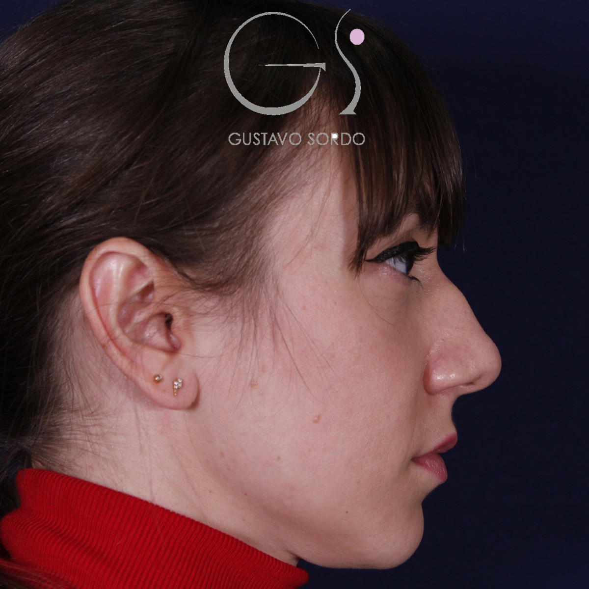 Antes de la rinoplastia étnica en nariz muy ancha y piel gruesa, vista de perfil derecho