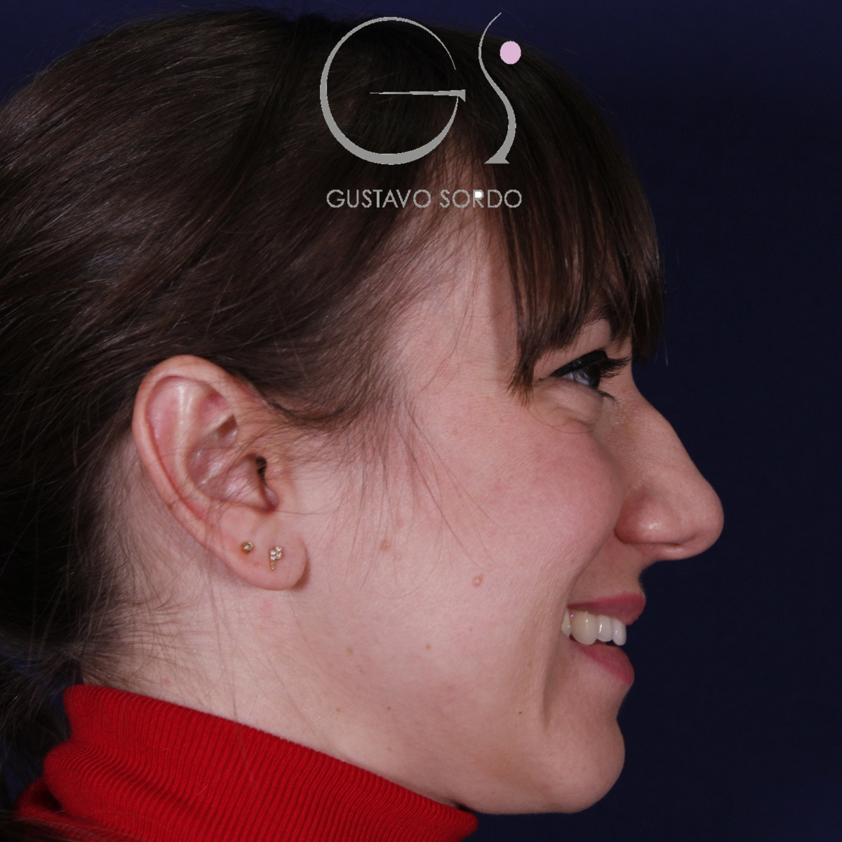 Antes de la rinoplastia étnica en nariz muy ancha y piel gruesa, vista de perfil derecho sonriendo