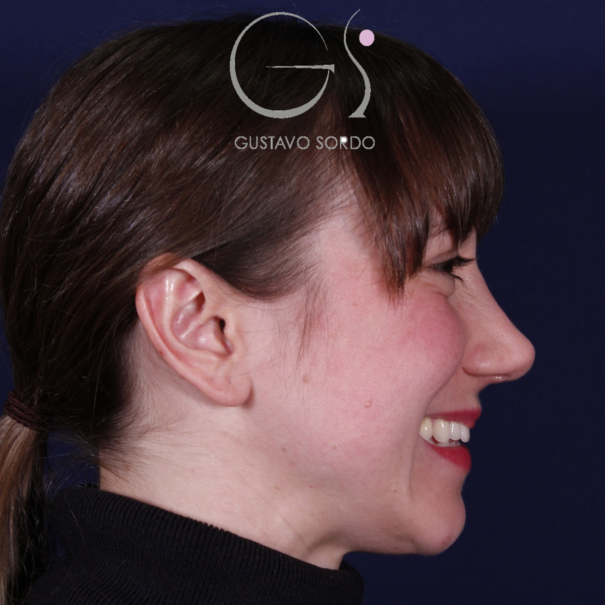 Después de la rinoplastia étnica en nariz muy ancha y piel gruesa, vista de perfil derecho sonriendo