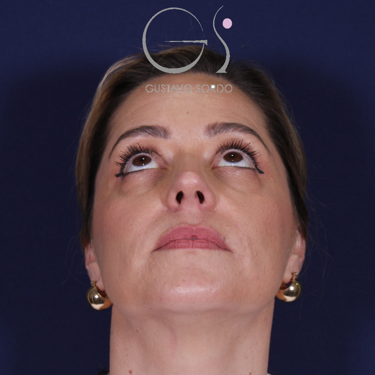 Rinoplastia ultrasónica, resultado tras la cirugía — caso operado por el Dr. Gustavo Sordo en Madrid (3)