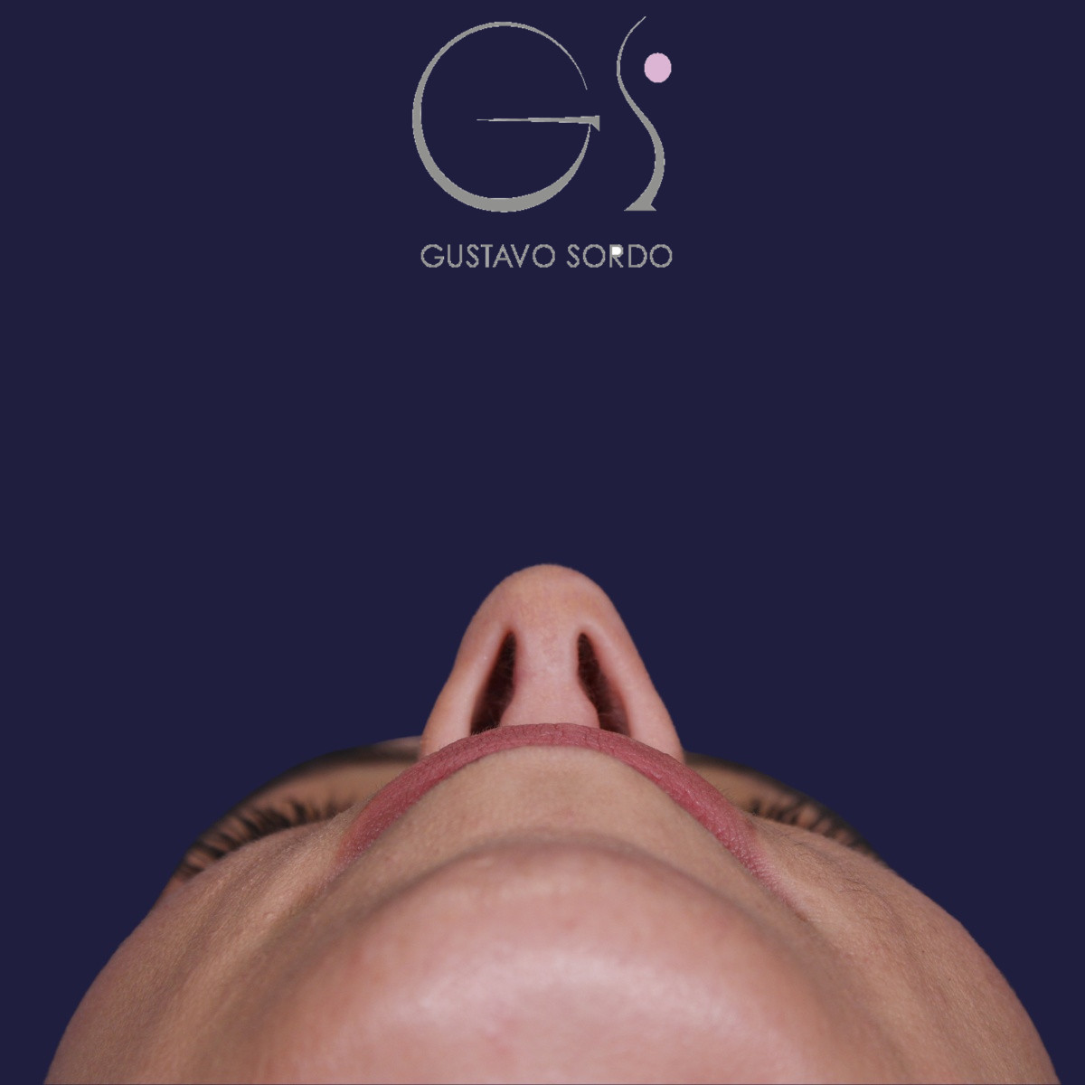 Rinoplastia ultrasónica, resultado tras la cirugía — caso operado por el Dr. Gustavo Sordo en Madrid (4)