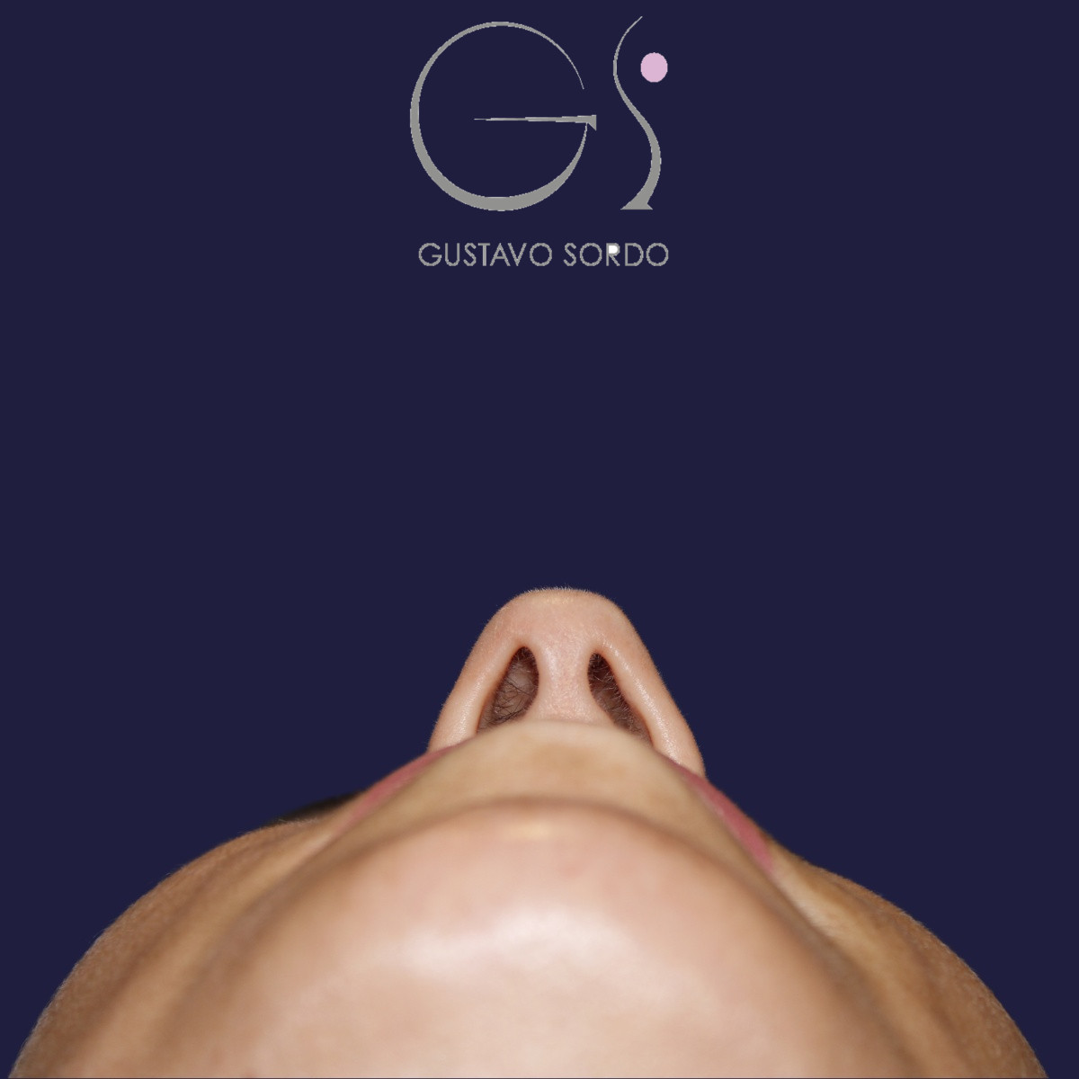 Rinoplastia ultrasónica, antes de la cirugía — caso operado por el Dr. Gustavo Sordo en Madrid (4)
