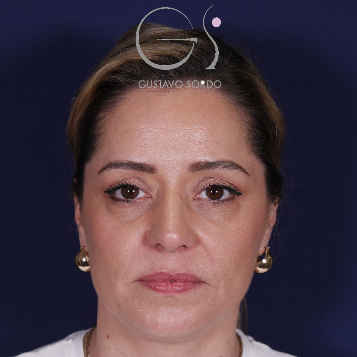 Rinoplastia ultrasónica, resultado tras la cirugía — caso operado por el Dr. Gustavo Sordo en Madrid (1)