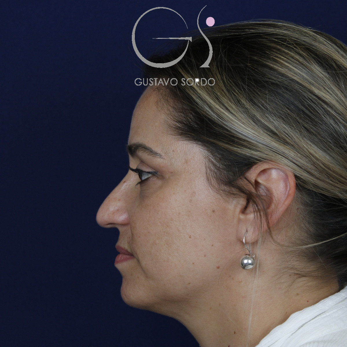 Rinoplastia ultrasónica, antes de la cirugía — caso operado por el Dr. Gustavo Sordo en Madrid (7)
