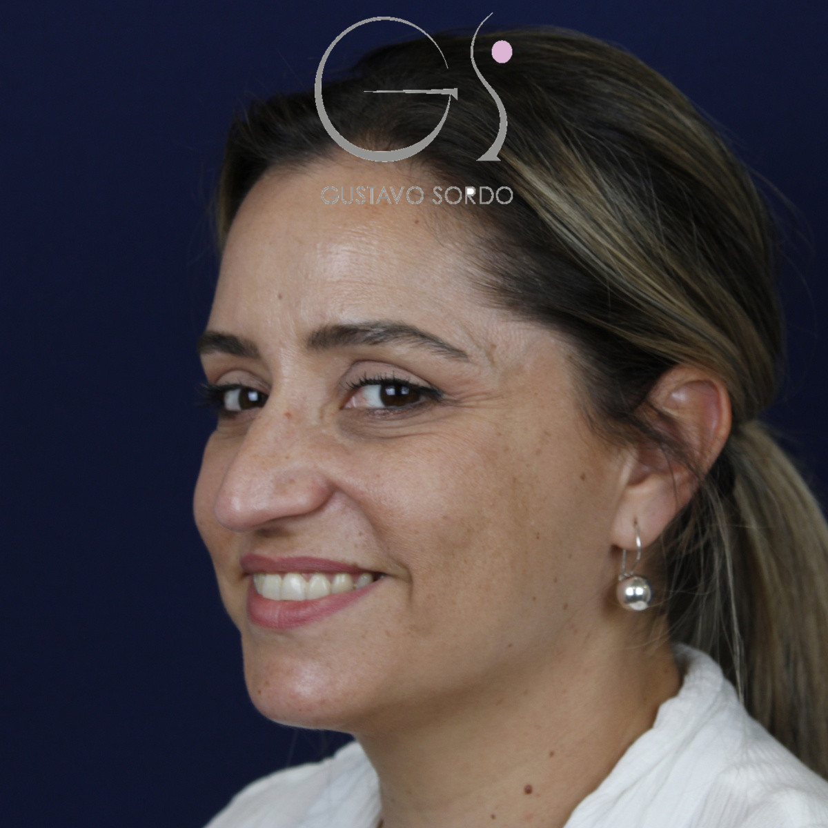 Rinoplastia ultrasónica, antes de la cirugía — caso operado por el Dr. Gustavo Sordo en Madrid (8)