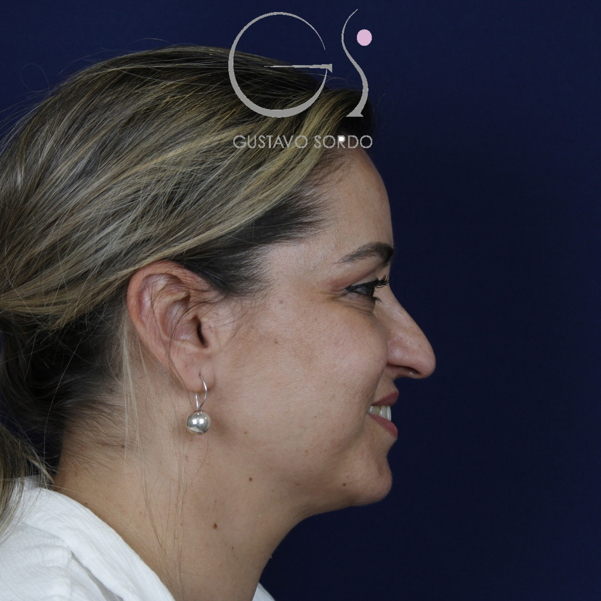 Rinoplastia ultrasónica, antes de la cirugía — caso operado por el Dr. Gustavo Sordo en Madrid (5)